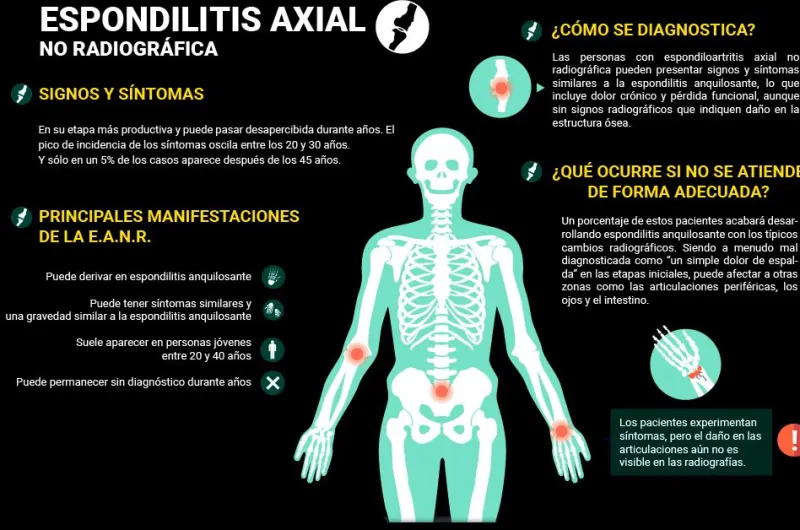 Una enfermedad reumatológica ocultar detrás del dolor de espaldas Se