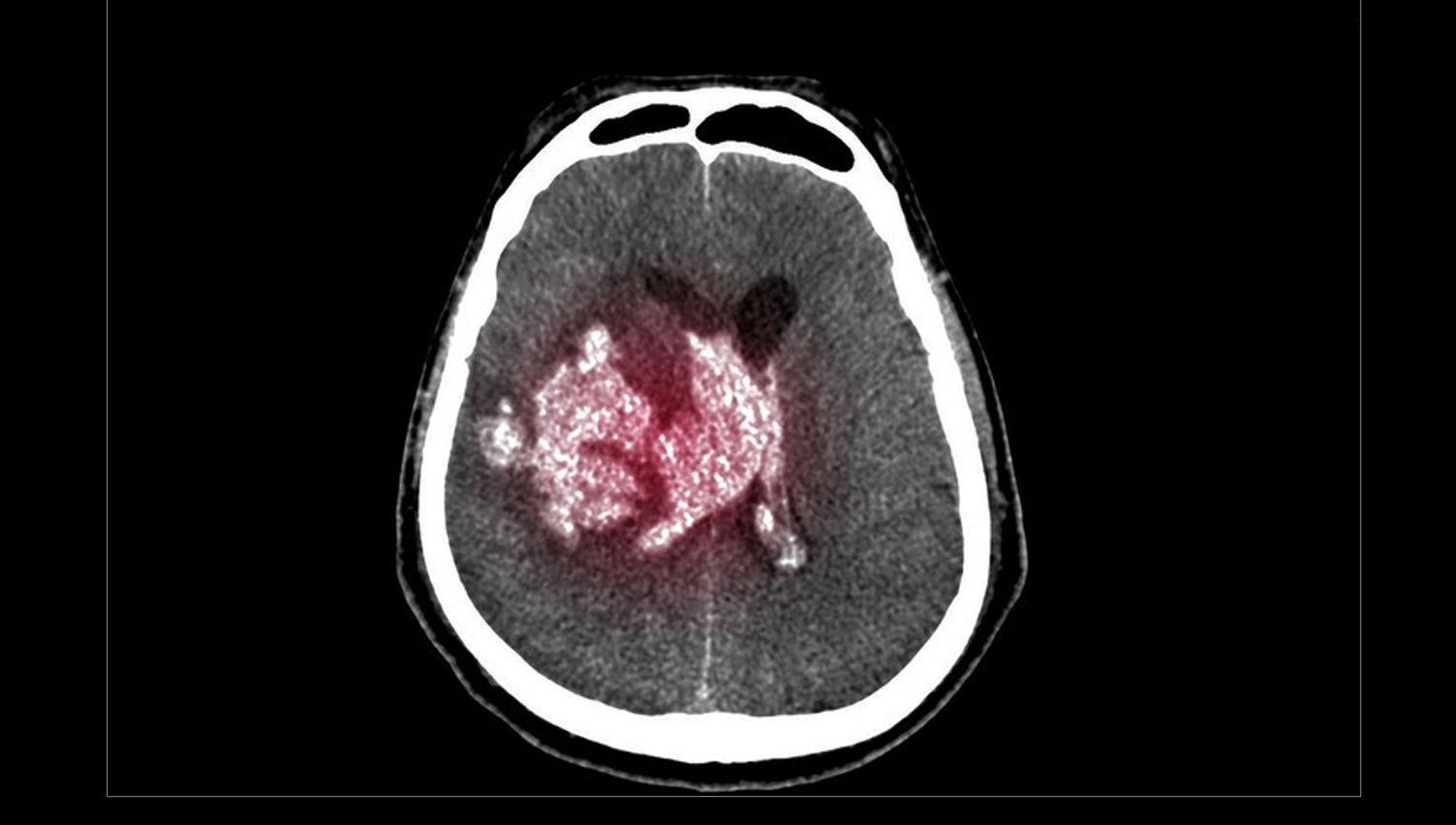 Queacute es y coacutemo se trata el hematoma subdural diagnosticado a Gonzaacutelez Garciacutea