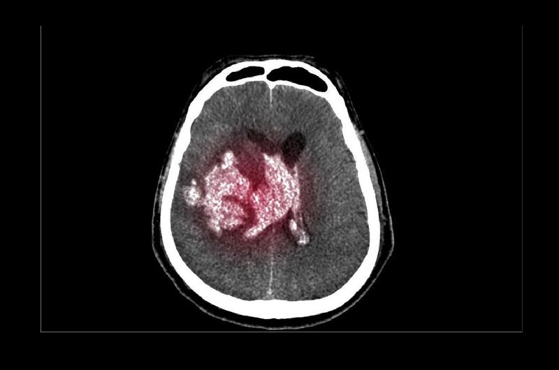 Queacute es y coacutemo se trata el hematoma subdural diagnosticado a Gonzaacutelez Garciacutea