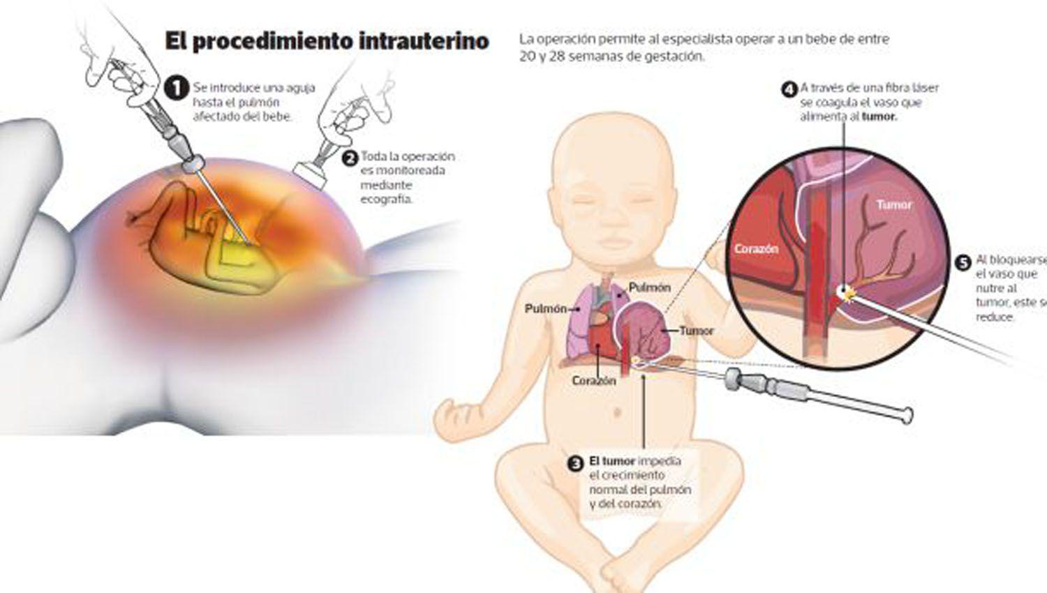 Argentina se incorporoacute a los paiacuteses que realizan cirugiacutea cardiacuteaca fetal