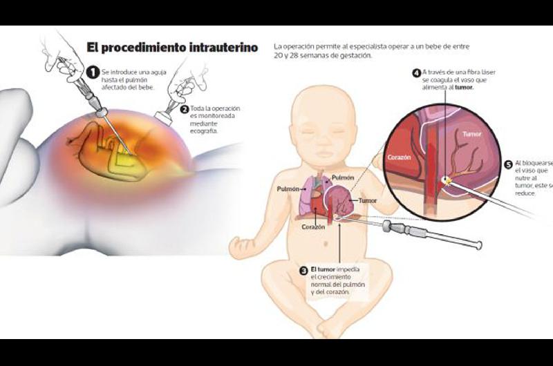 Argentina se incorporoacute a los paiacuteses que realizan cirugiacutea cardiacuteaca fetal