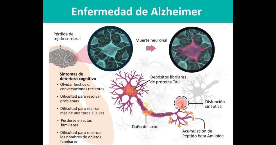 Especialista califica de alentadora a una nueva terapia para tratar el Alzheimer