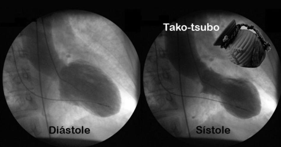 Siacutendrome del corazoacuten roto- una afeccioacuten cardiacuteaca maacutes seria que una simple metaacutefora