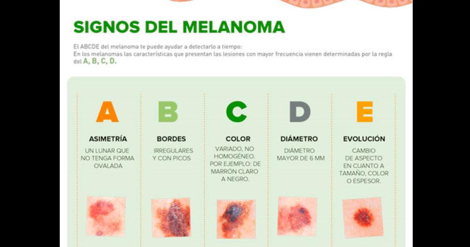 Por el aumento de casos de melanoma sugieren revisar los lunares de extrantildeo aspecto