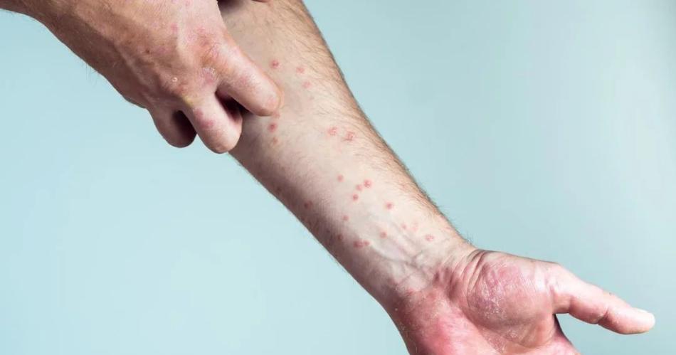 Descubren nueva propiedad de remedio para la psoriasis