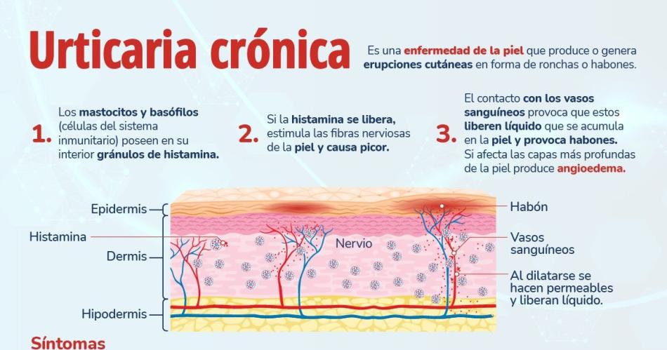 Especialistas aseguran que la urticaria croacutenica tiene un elevado impacto en la calidad de vida