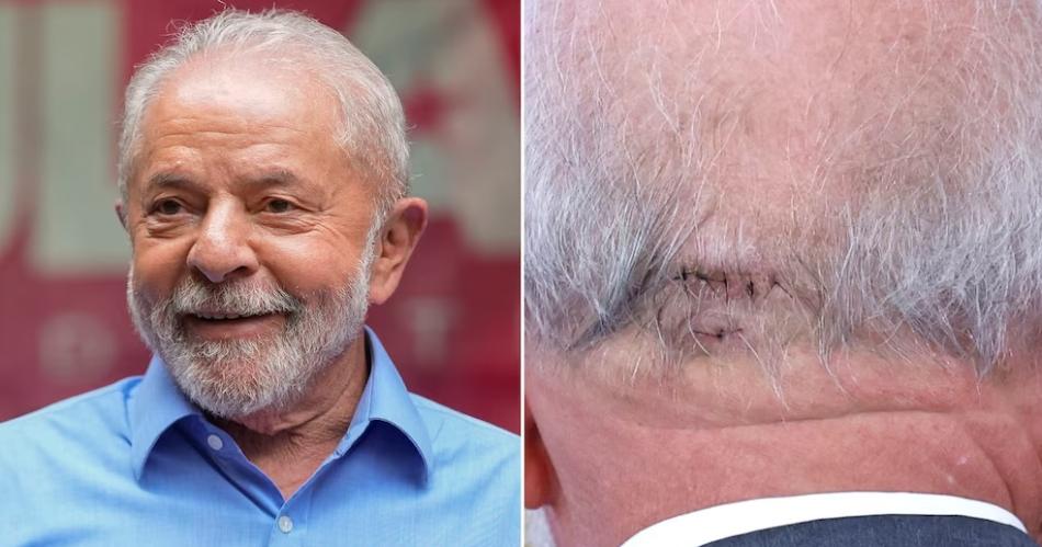 Lula fue operado de urgencia por una hemorragia intracraneal