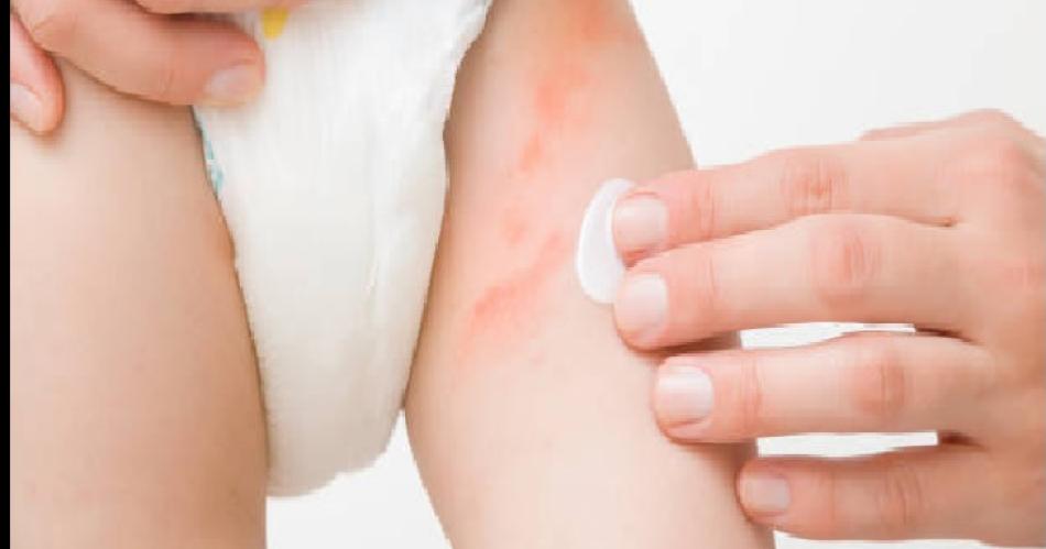 El calor y la humedad generan estragos en la piel- alerta por irritaciones dermatitis y verrugas