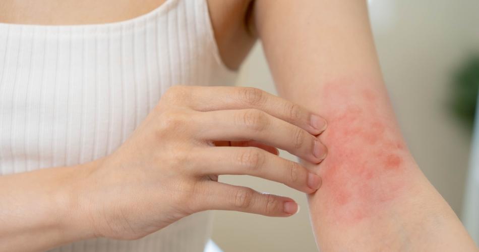 El calor y la humedad generan estragos en la piel- alerta por irritaciones dermatitis y verrugas